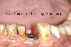 Placement of healing abutment