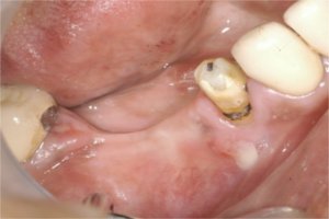 Please note the pus from the abscess in the 1st premolar region