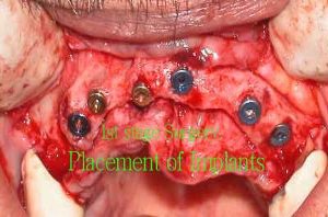 Placement of implants