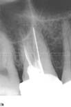 Before treatment - a failed root canal done by previous dentist