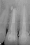 1. Before treatment - persistent periapical lesion