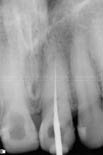 Calcified canals of both the upper central incisors