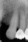 Radiograph of Right Lateral  incisor
