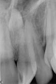 Radiograph - supernumerary (mesiodens) tooth