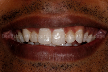 Before treatment - Smile