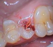 The patient came to the clinic with pain in the tooth