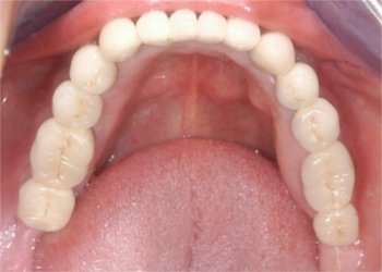 After treatment - Occlusal view