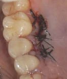Palate donor site - sutured