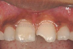Right central incisor repaired