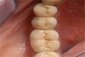 Implant supported prosthesis - an occlusal view