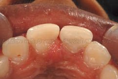 Palatal view after treatment