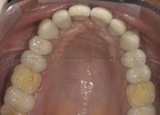 Upper arch after treatment