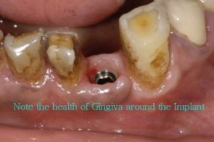 Note the health of the gingiva around the implant