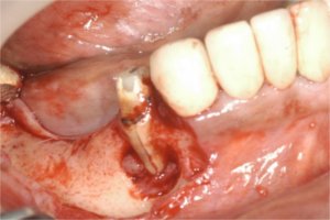 Vertical fracture, granulation tissue and total loss of buccal cortical plate can be clearly seen