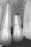 2. After removal of apical part, MTA placed
