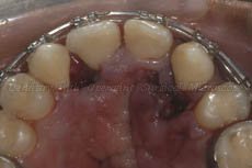 Empty sockets after tooth extraction