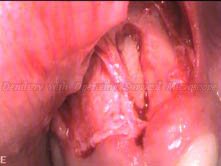 Impacted mesiodens tooth