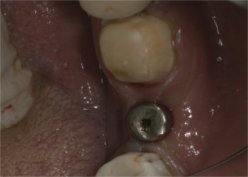 Placement of the gingival former. A prosthesis can be immediately placed