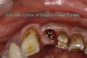 Note the contour of the gingiva around the implant