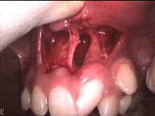After extraction of the impacted tooth