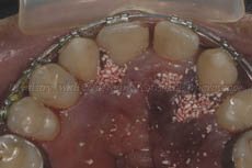 Placement-of-bone-graft-in-the-empty-sockets