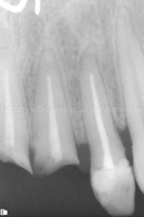Radiograph-Tooth-to-be-repeat-root-canal-treated