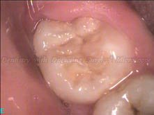 3.1. Carious erupted wisdom tooth