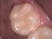 3.3. Invisible flling on the wisdom tooth