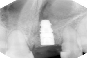 Radiograph after placement of implant
