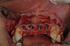 Implants placed in upper arch