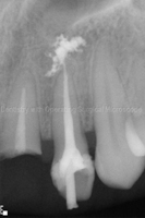 Repeat-root-canal-treatment