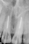 Root canal treated anterior teeth- strengthened with cosmetic screwposts