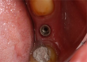 Close up of healed implant