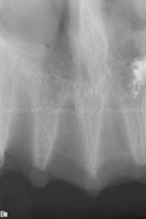 Empty tooth sockets after extraction