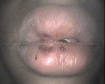 Injured lip