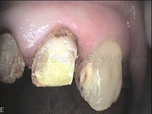 Left Lateral Incisor is symptomatic. Proximal caries on the canine