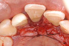 The pus was removed and it is seen that the tooth has got approximately 1.5mm bone support