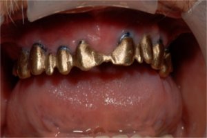 Precious metal trial of the upper implant prosthesis