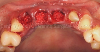 Bone graft placement in sockets