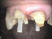 Intra-oral Photo Showing Fiberpost used for Reinforcement