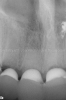 Radiograph showing grafted bone