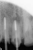 Reinforcement of endodontically treated teeth with  screwpost