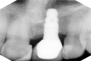 Radiograph - After treatment