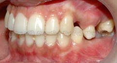Before treatment – malposition of upper tooth