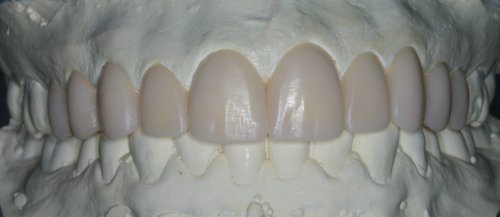 Model after wax-up