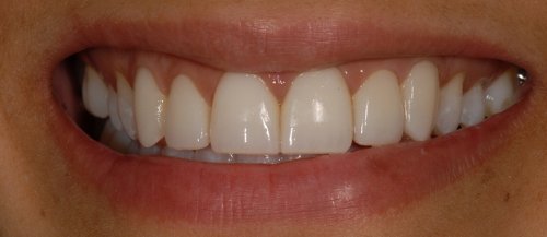 Smile - after treatment
