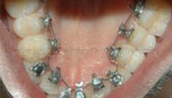  Lingual Orthodontics